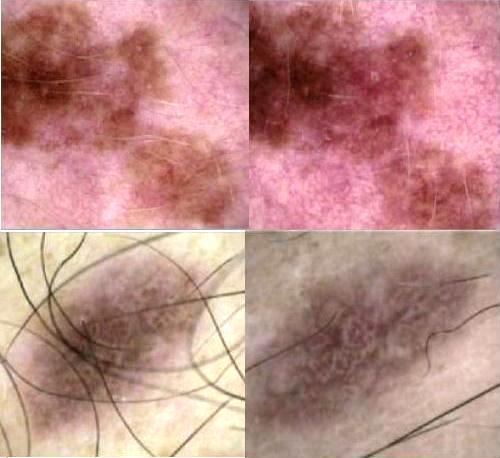 evoluzione melanoma